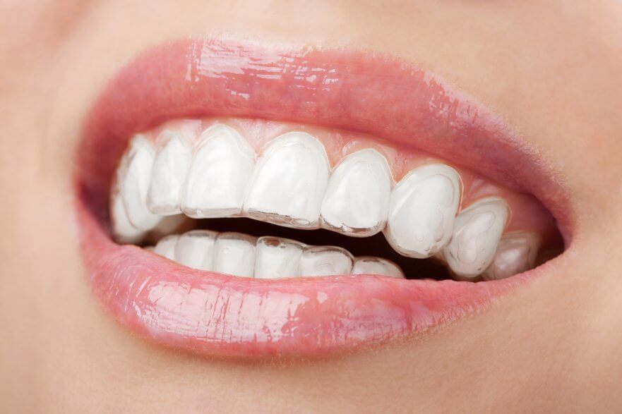 A photo of a smiling mouth with Invisalign clear mouth trays. Ivy Lane Dentistry offers Invisalign orthodontic trays for straightening smiles in San Antonio, TX.