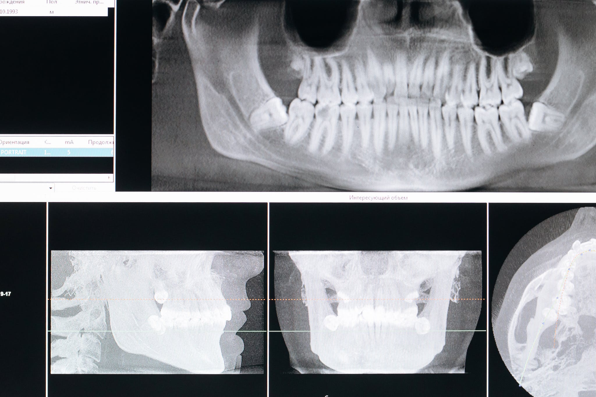 Close-Up Shot of Xray of Mouth. Ivy Lane Dentistry offers oral cancer screening services in San Antonio, TX.