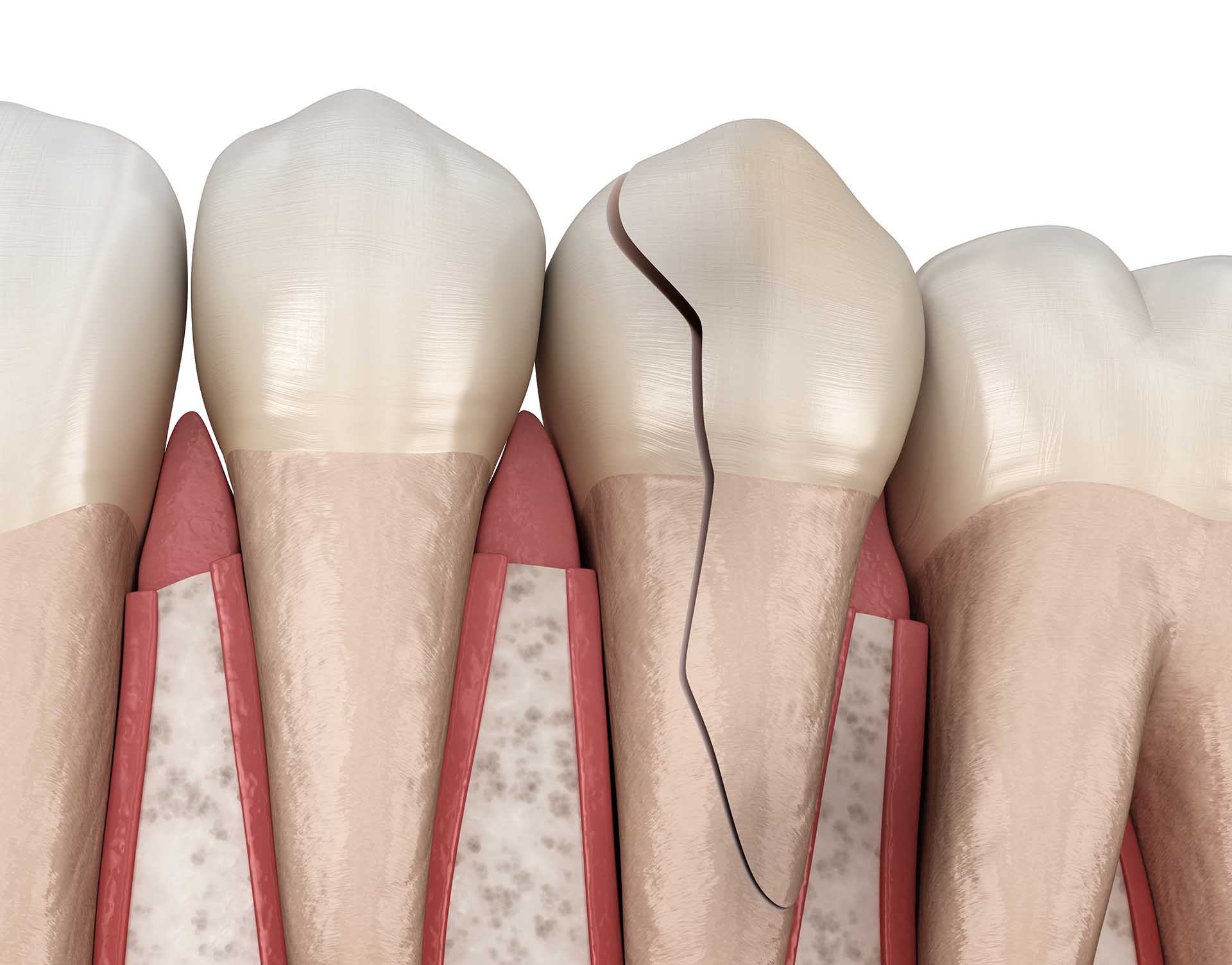 Cracked tooth, splitted. Dental 3D illustration. Ivy Lane Dentistry offers emergency care for broken teeth in San Antonio, TX.