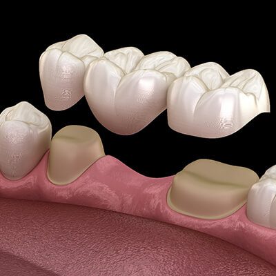 Infographic of human in dental bridge on white background illustration.  Ivy Lane Dentistry offers Dental Bridges in San Antonio, TX. <a href="https://www.freepik.com/free-vector/infographic-human-dental-bridge-white-background_24779460.htm#query=dental%20bridge&position=0&from_view=keyword&track=ais">Image by brgfx</a> on Freepik