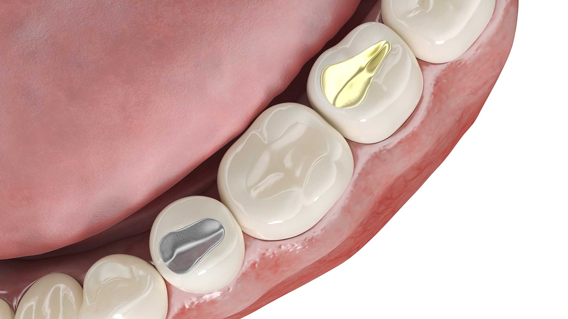 3d rendered illustration of different dental fillings. Ivy Lane Dentistry offers solutions for lost fillings requiring emergency dentistry care in San Antonio, TX.
