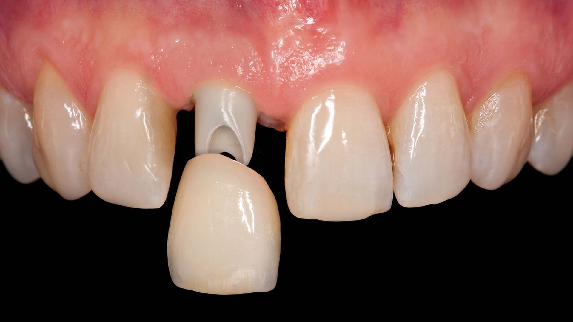 Image of a frontal tooth crown. Ivy Lane Dentistry offers emergency dental support for lost crowns in San Antonio, TX