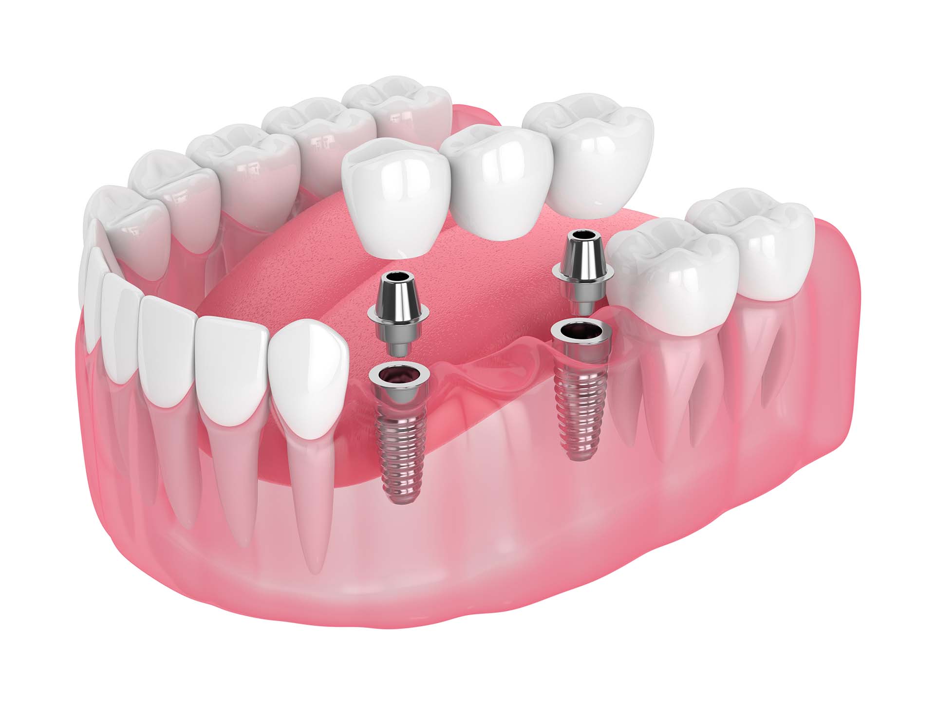 3d render of jaw with implants supported dental bridge isolated over white background. Ivy Lane Dentistry offers multiple tooth implants for patients in San Antonio, TX. 
