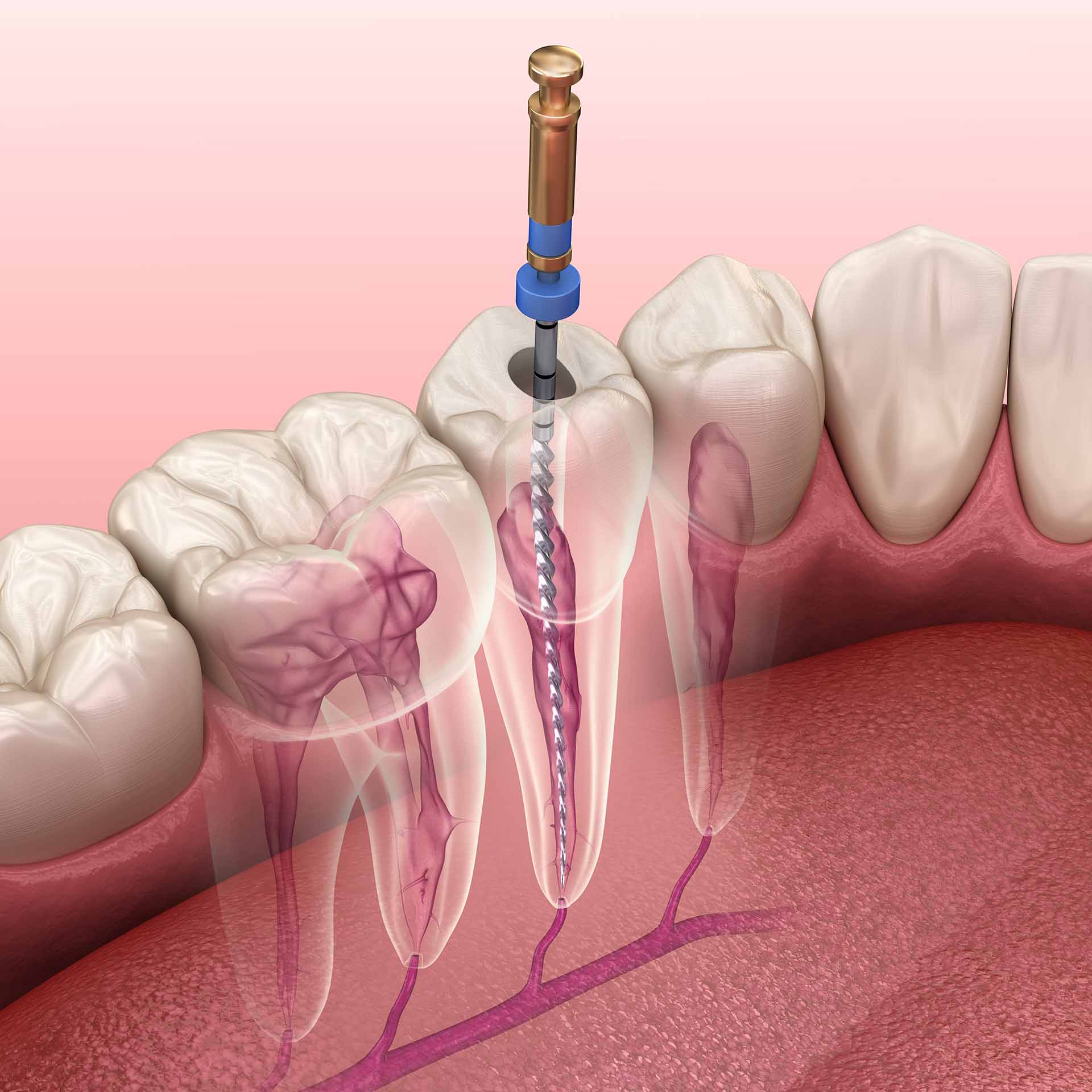 Endodontic root canal treatment process. Medically accurate tooth 3D illustration. Ivy Lane Dentistry offers root canal treatment for patients in San Antonio, TX