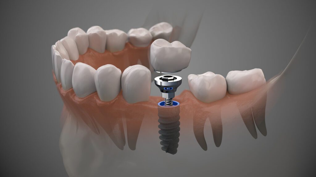 Tooth human implant. On1 concept. Dental prosthetic innovation. Ivy Lane Dentistry offers single tooth implants as a service in San Antonio, TX.
