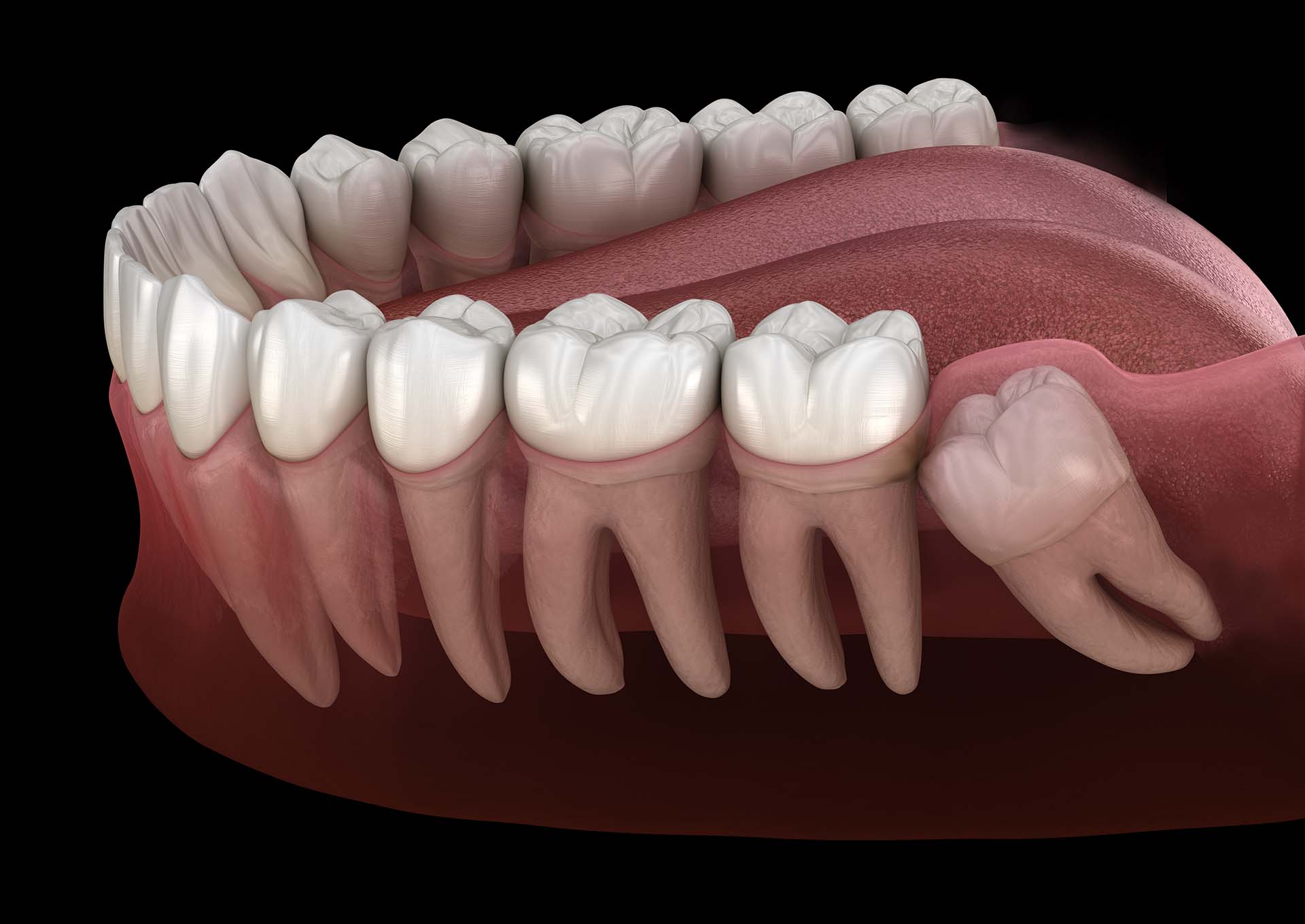 Healthy teeth and wisdom tooth with mesial impaction . Medically accurate tooth 3D illustration. Ivy Lane Dentistry treats wisdom teeth for patients throughout San Antonio, TX.