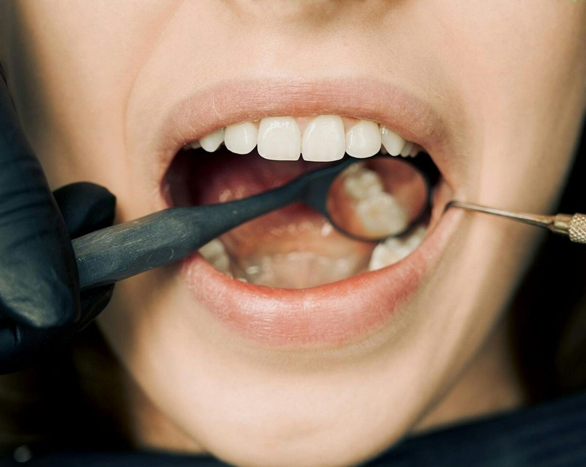 Dentist Checking Teeth of a Person. Ivy Lane Dentistry specializes in preventing gum disease in San Antonio, TX.