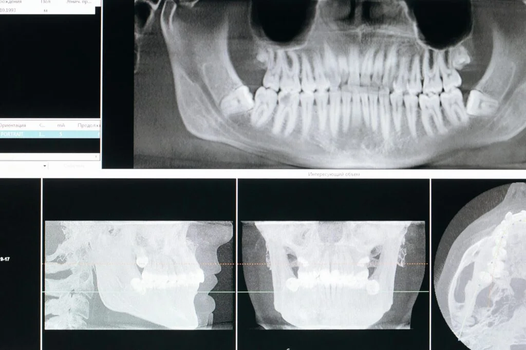 Maintaining Bone Health Post-Extraction